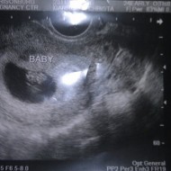 The Big Ultrasound Milestone
