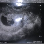 The Big Ultrasound Milestone
